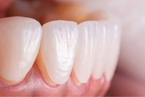 طول عمر لمینیت های سرامیکی